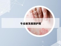 牛皮癣发展期护理