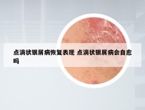 点滴状银屑病恢复表现 点滴状银屑病会自愈吗