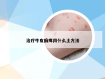 治疗牛皮癣痒用什么土方法