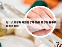 为什么怀孕后突然得了牛皮癣 怀孕后有牛皮癣怎么办呀