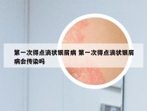 第一次得点滴状银屑病 第一次得点滴状银屑病会传染吗