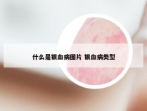 什么是银血病图片 银血病类型