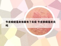 牛皮癣就是身体里有了炎症 牛皮肤癣是皮炎吗