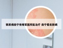 银屑病南宁有哪家医院能治疗 南宁看皮肤病