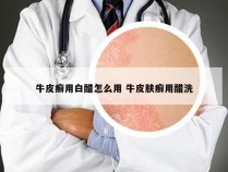 牛皮癣用白醋怎么用 牛皮肤癣用醋洗