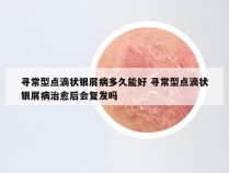 寻常型点滴状银屑病多久能好 寻常型点滴状银屑病治愈后会复发吗