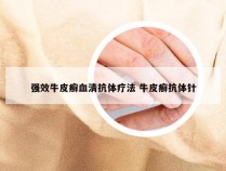强效牛皮癣血清抗体疗法 牛皮癣抗体针