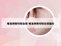 嘴角两侧对称白斑 嘴角两侧对称白斑图片