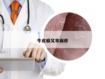 牛皮癣又荨麻疹