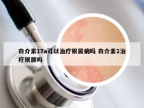 白介素17a可以治疗银屑病吗 白介素2治疗银屑吗
