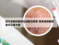 烧牛皮癣的医院在成都的哪里 银屑病成都哪里可以看中医