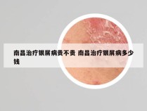 南昌治疗银屑病贵不贵 南昌治疗银屑病多少钱