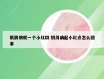 银屑病就一个小红斑 银屑病起小红点怎么回事