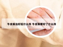 牛皮癣治好后什么样 牛皮癣要好了什么样