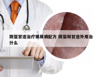 斑蝥甘遂治疗银屑病配方 斑蝥和甘遂外用治什么