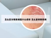 怎么区分银屑病是什么症状 怎么鉴别银屑病