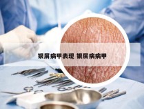 银屑病甲表现 银屑病病甲