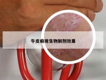 牛皮癣用生物制剂效果