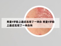 男童9岁脸上最近出现了一块白 男童9岁脸上最近出现了一块白块