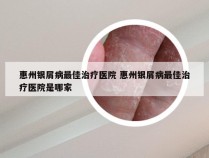 惠州银屑病最佳治疗医院 惠州银屑病最佳治疗医院是哪家