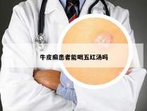 牛皮癣患者能喝五红汤吗