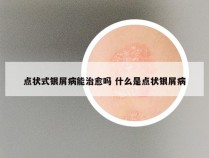 点状式银屑病能治愈吗 什么是点状银屑病