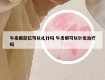 牛皮癣部位可以扎针吗 牛皮癣可以针灸治疗吗