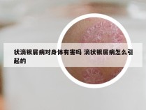 状滴银屑病对身体有害吗 滴状银屑病怎么引起的
