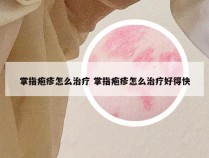 掌指疱疹怎么治疗 掌指疱疹怎么治疗好得快