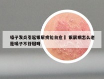 嗓子发炎引起银屑病能自愈嚒 银屑病怎么老是嗓子不舒服呀