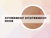 光疗对银屑病的治疗 光疗治疗银屑病多长时间见效果