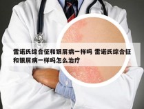 雷诺氏综合征和银屑病一样吗 雷诺氏综合征和银屑病一样吗怎么治疗