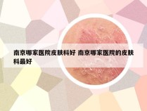 南京哪家医院皮肤科好 南京哪家医院的皮肤科最好