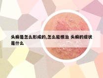 头癣是怎么形成的,怎么能根治 头癣的症状是什么