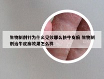 生物制剂针为什么见效那么快牛皮癣 生物制剂治牛皮癣效果怎么样