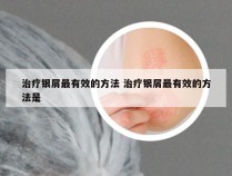 治疗银屑最有效的方法 治疗银屑最有效的方法是