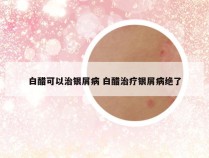 白醋可以治银屑病 白醋治疗银屑病绝了