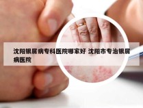沈阳银屑病专科医院哪家好 沈阳市专治银屑病医院