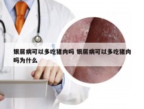 银屑病可以多吃猪肉吗 银屑病可以多吃猪肉吗为什么