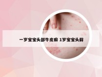 一岁宝宝头部牛皮癣 1岁宝宝头藓
