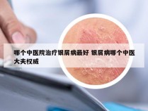 哪个中医院治疗银屑病最好 银屑病哪个中医大夫权威