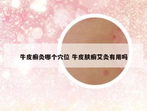 牛皮癣灸哪个穴位 牛皮肤癣艾灸有用吗