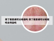 得了银屑病可以吸烟吗 得了银屑病可以吸烟吗会传染吗