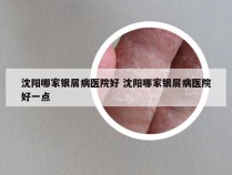 沈阳哪家银屑病医院好 沈阳哪家银屑病医院好一点