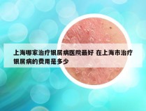 上海哪家治疗银屑病医院最好 在上海市治疗银屑病的费用是多少