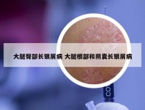 大腿臀部长银屑病 大腿根部和阴囊长银屑病