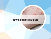 得了牛皮癣可不可以做b超