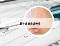 得牛皮癣会遗传吗