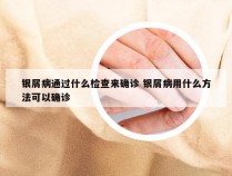 银屑病通过什么检查来确诊 银屑病用什么方法可以确诊
