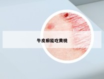 牛皮癣能吃黄桃